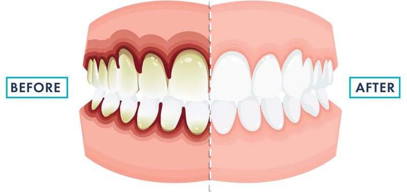 LivFresh Gel Toothpaste 15